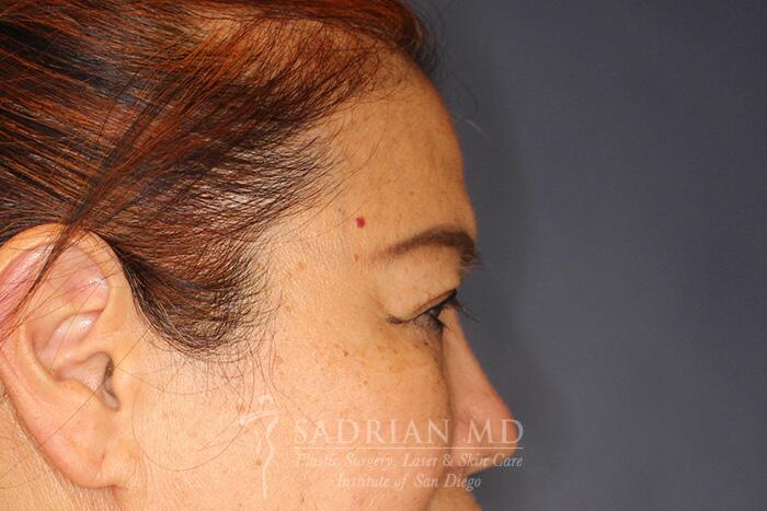 Brow Forehead Lift Before & After Image