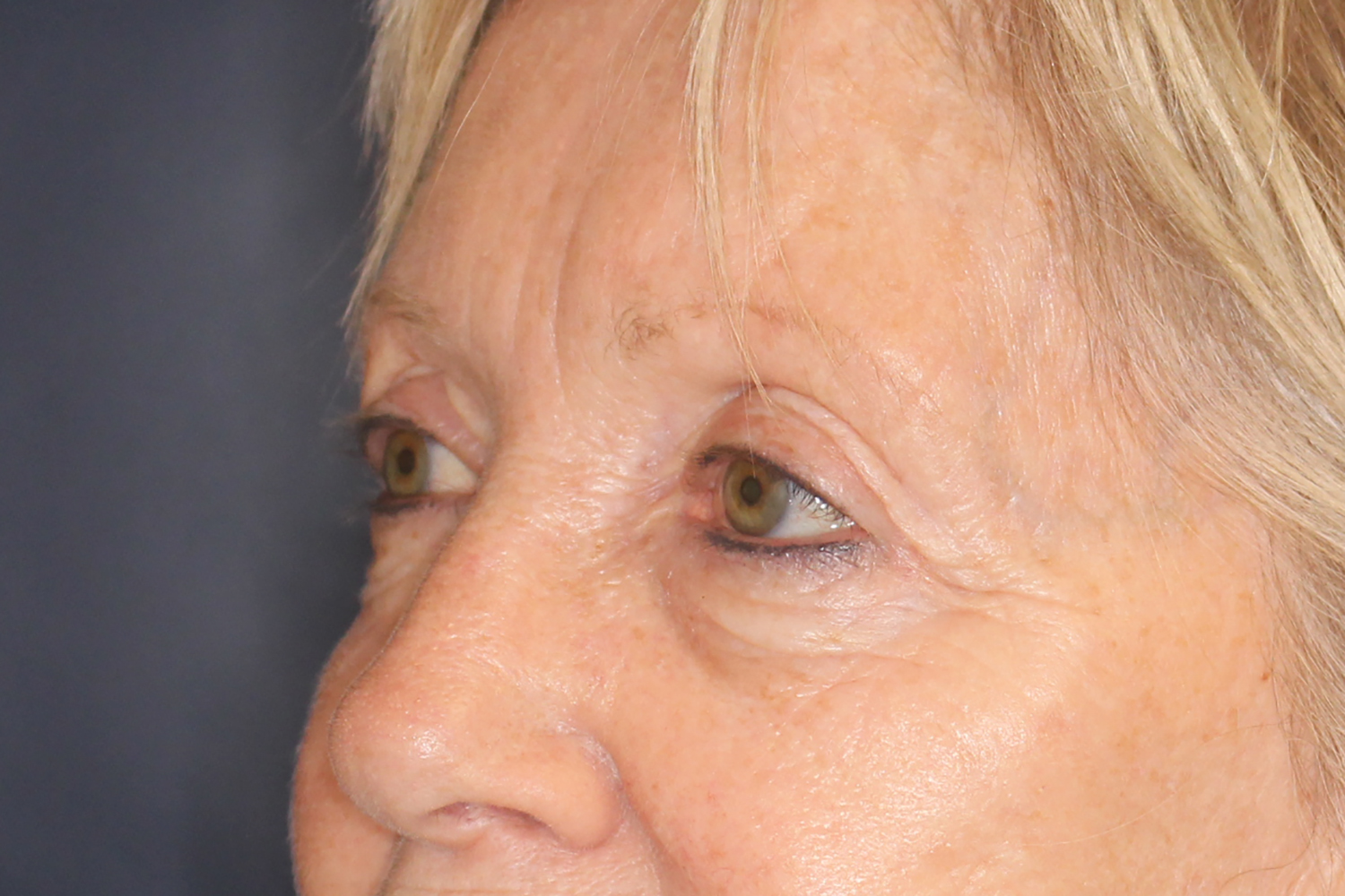 Brow Forehead Lift Before & After Image