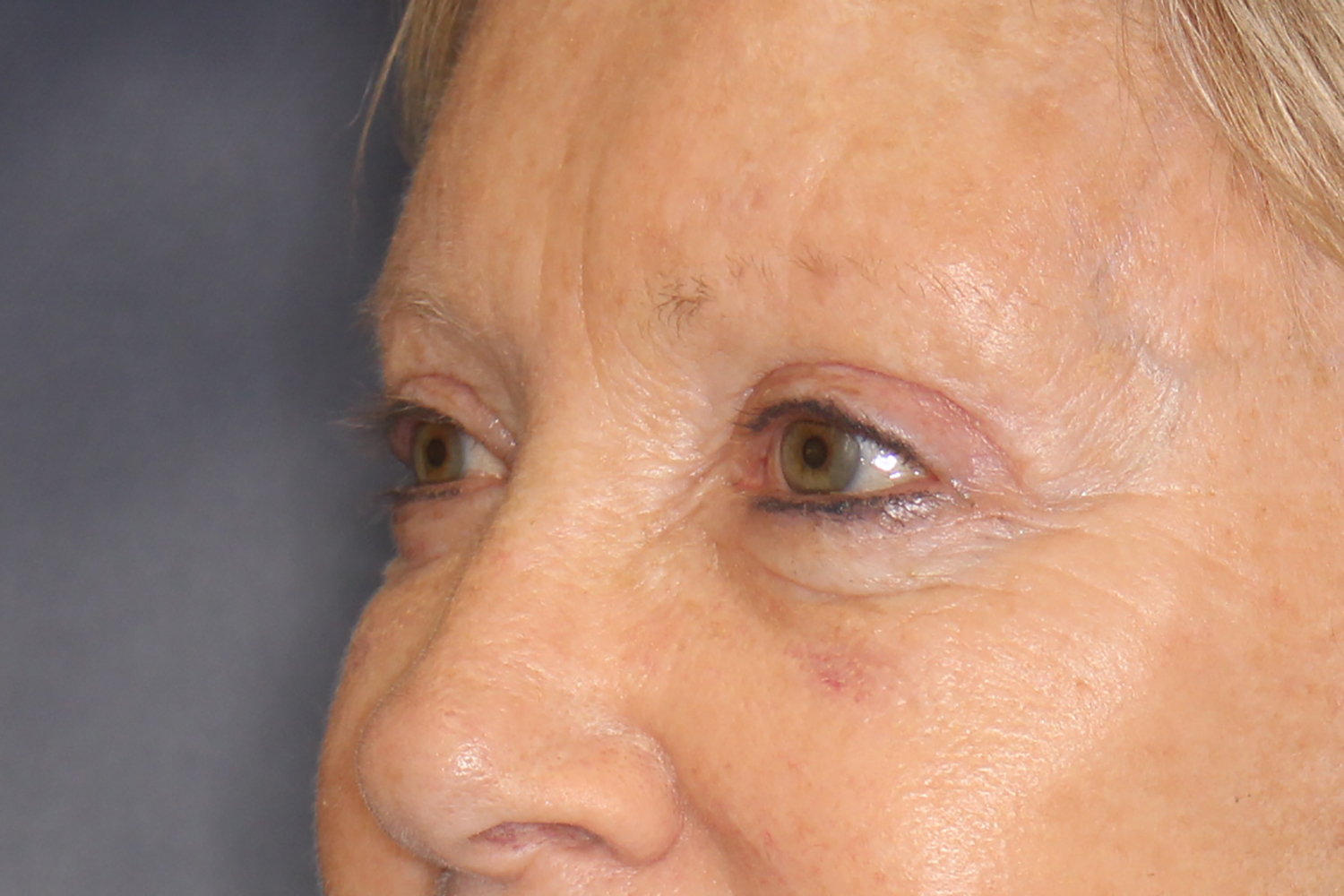 Brow Forehead Lift Before & After Image