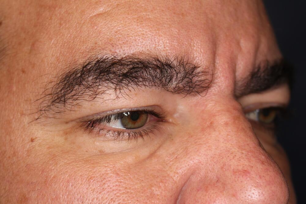 Brow Forehead Lift Before & After Image