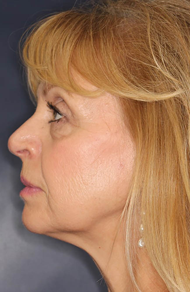 Face & Neck Lift Before & After Image