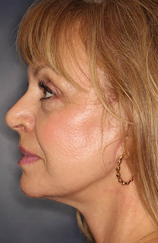 Face & Neck Lift Before & After Image