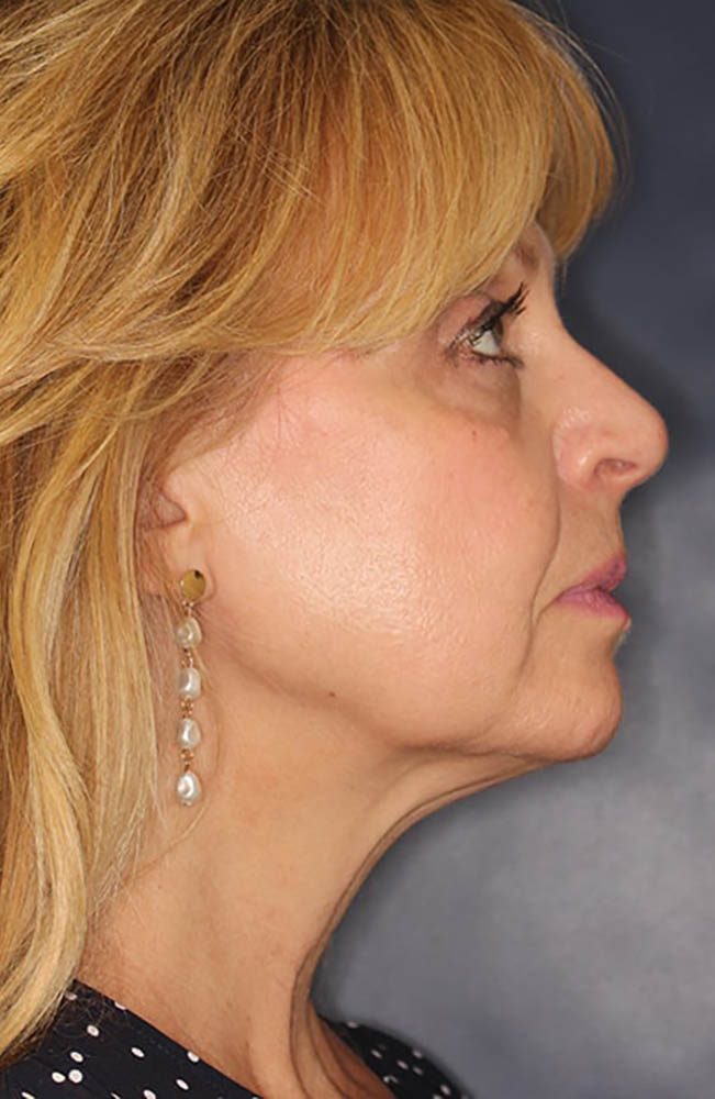 Face & Neck Lift Before & After Image