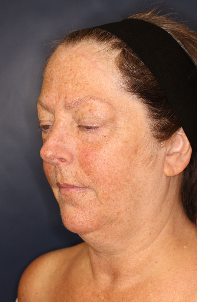 Face & Neck Lift Before & After Image