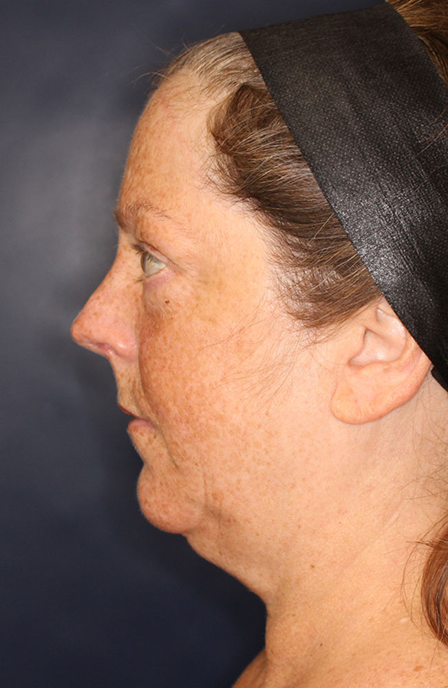 Face & Neck Lift Before & After Image