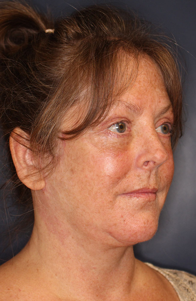 Face & Neck Lift Before & After Image