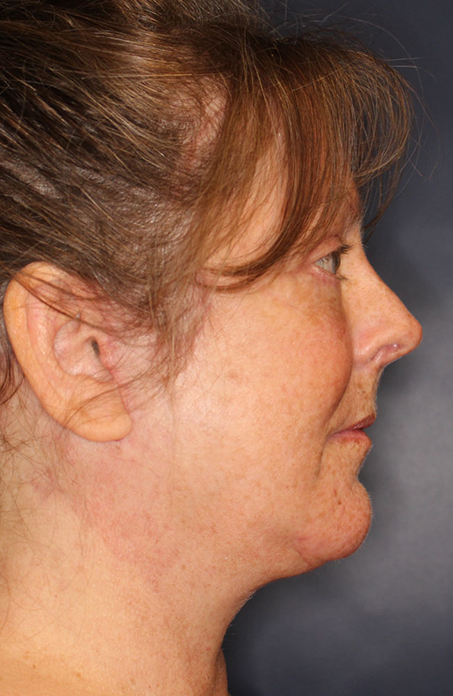 Face & Neck Lift Before & After Image