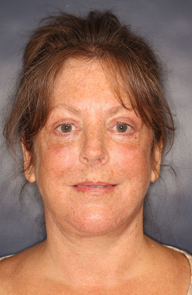 Face & Neck Lift Before & After Image