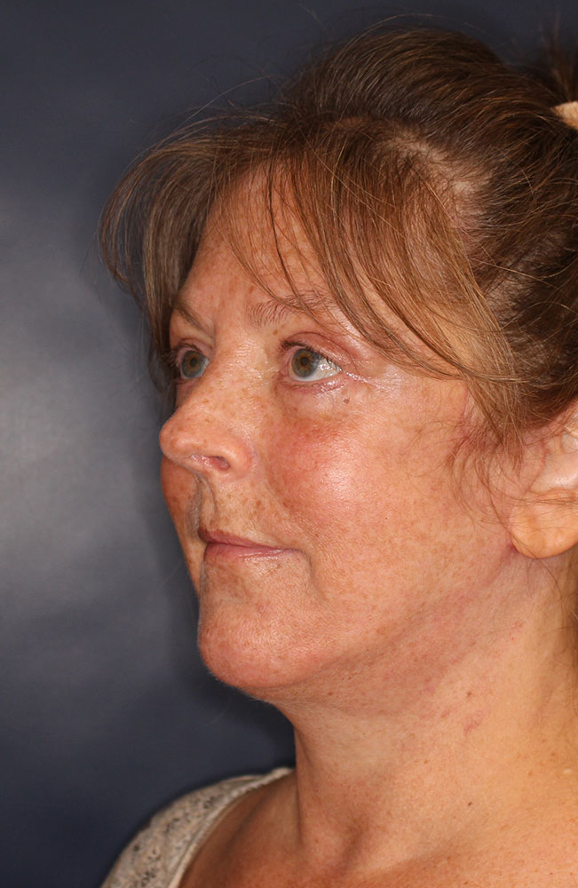 Face & Neck Lift Before & After Image