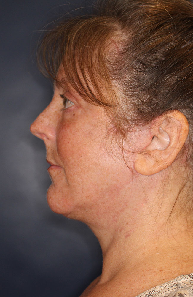 Face & Neck Lift Before & After Image