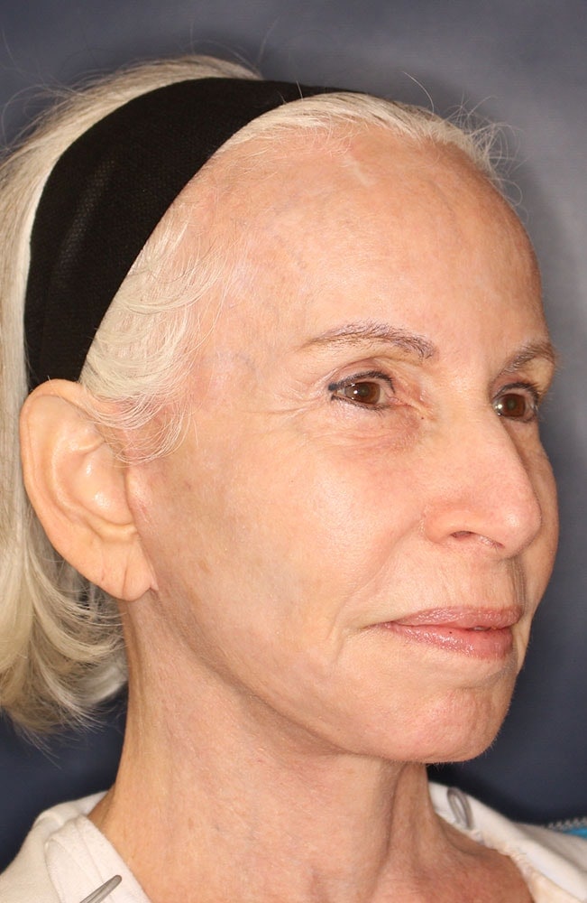 Face & Neck Lift Before & After Image