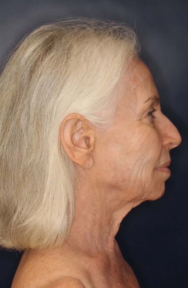 Face & Neck Lift Before & After Image