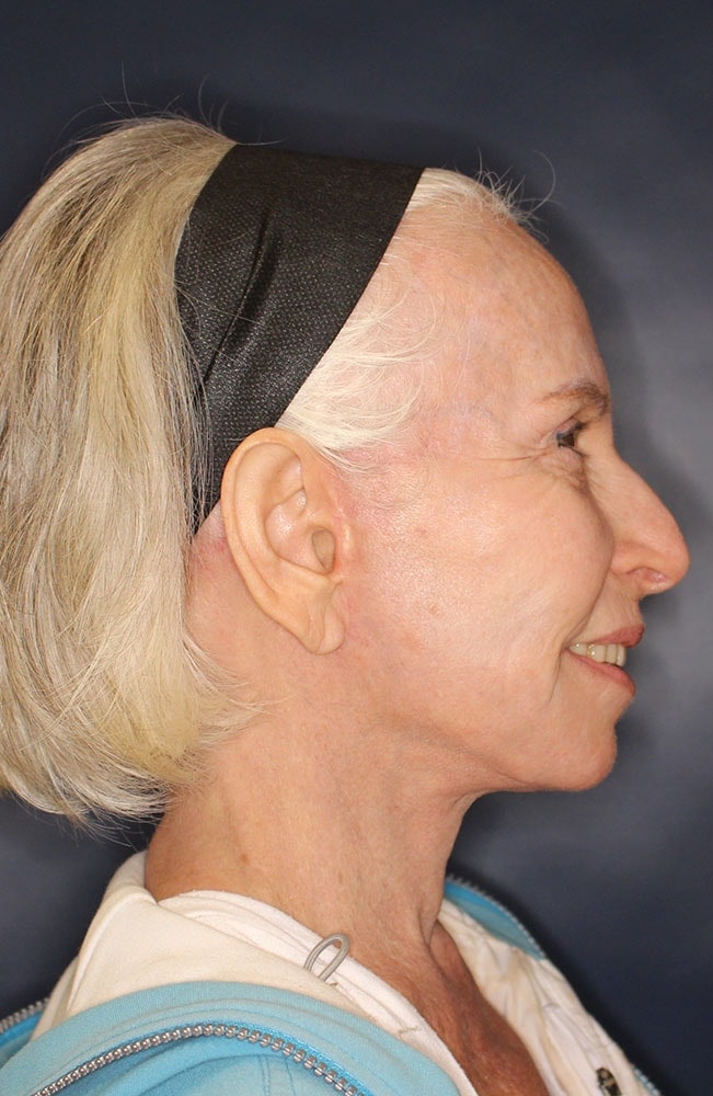 Face & Neck Lift Before & After Image