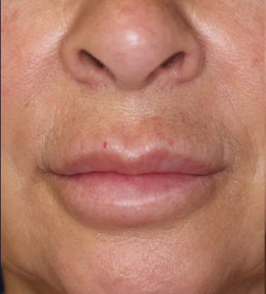 Lip Lift Before & After Image