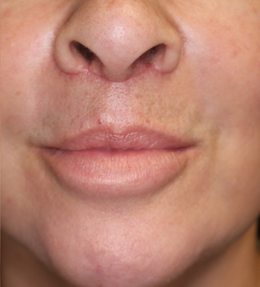 Lip Lift Before & After Image