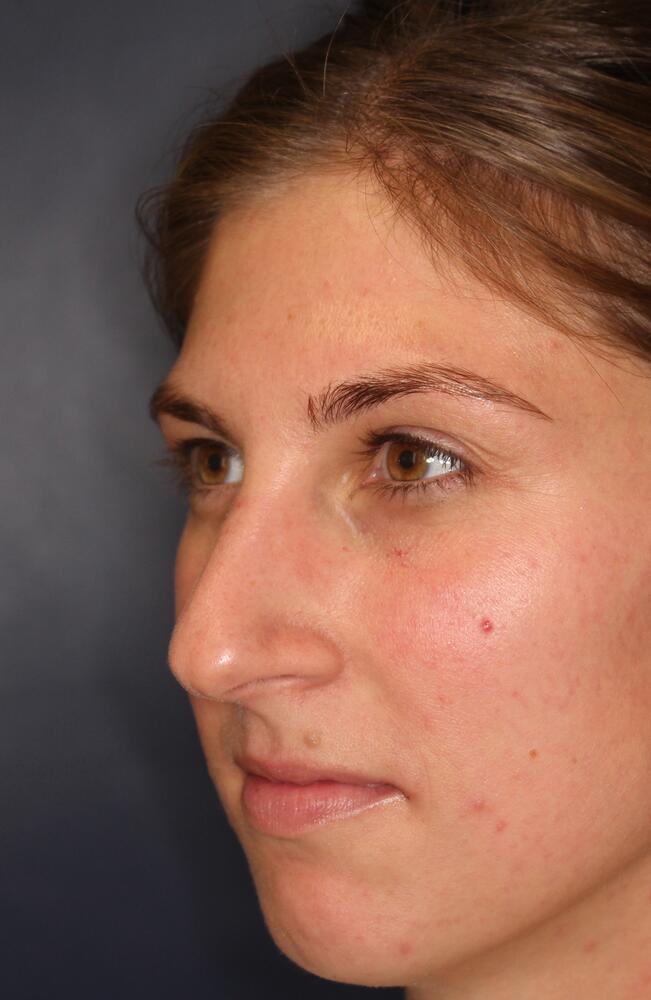 Nose Reshaping Before & After Image