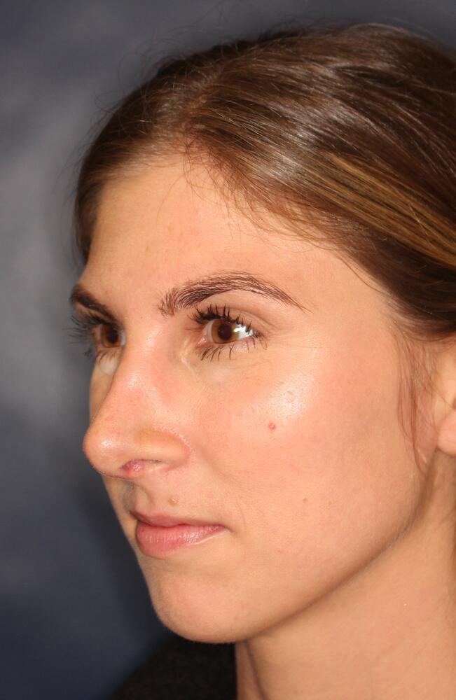 Nose Reshaping Before & After Image