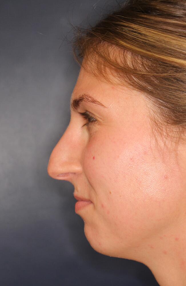 Nose Reshaping Before & After Image