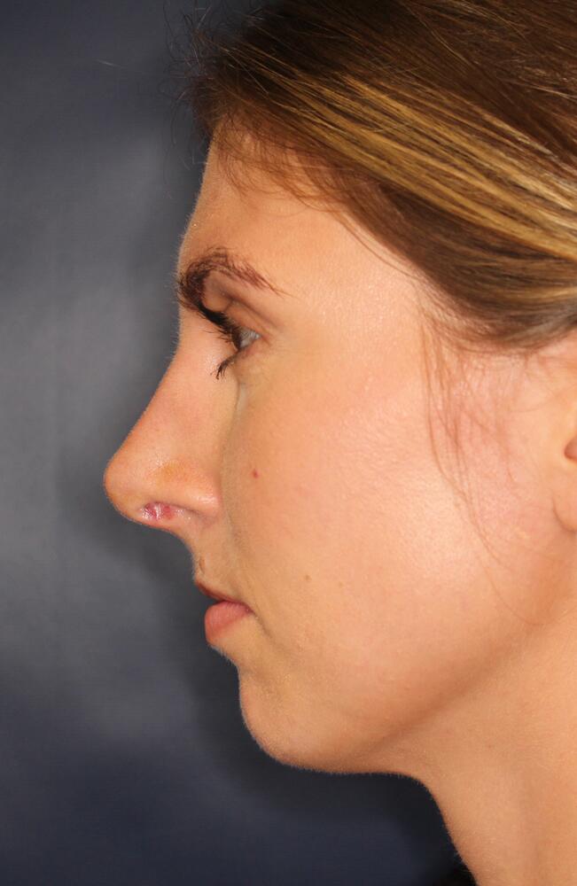 Nose Reshaping Before & After Image